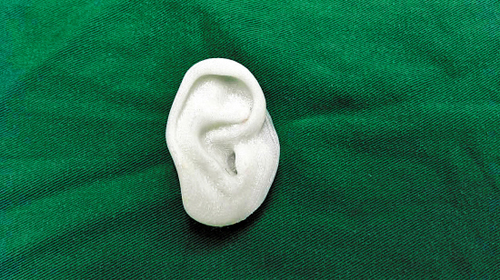 3D打印将助女童长出新耳